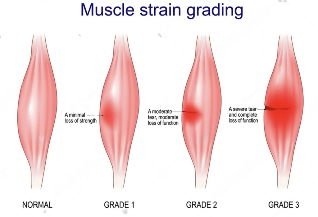 muscle stain grading