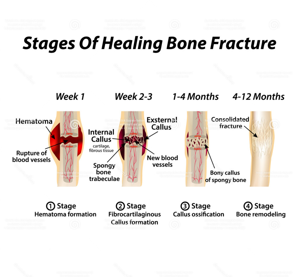 Stages of bone healing