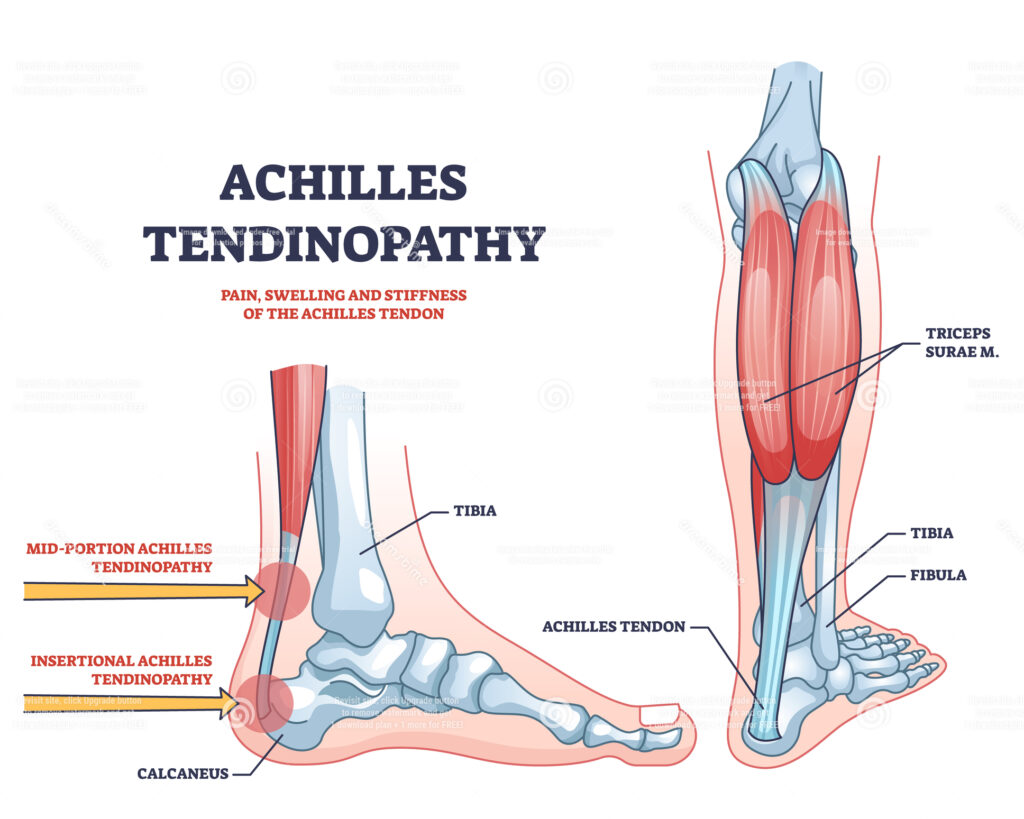 Achilles tendon