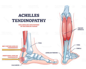 Achilles tendon